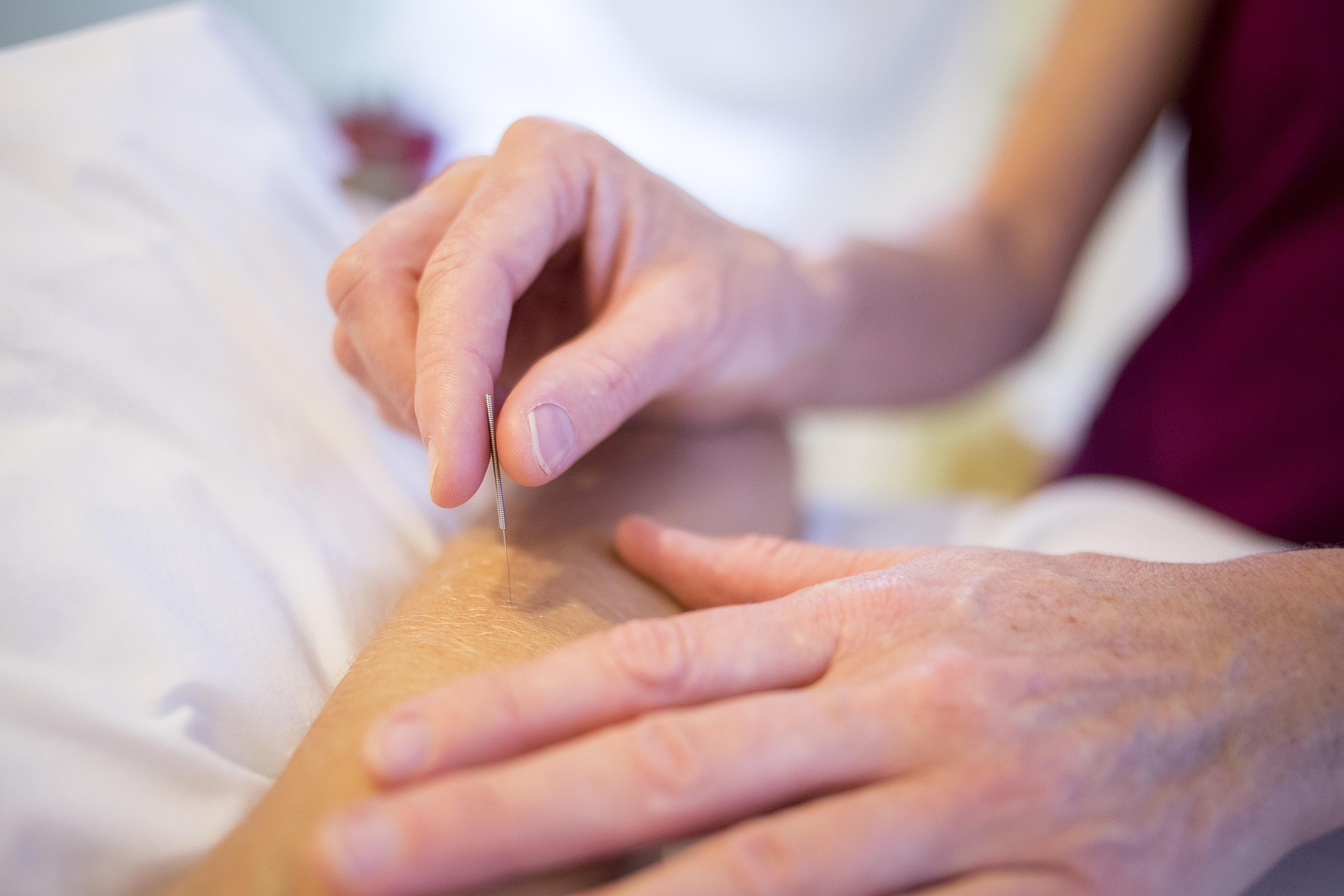 acupuncture-5126777_1920